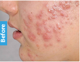 Before Acne Treatment