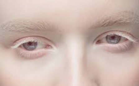Albinism Awareness Image