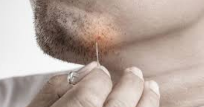 Ingrown Hair Image