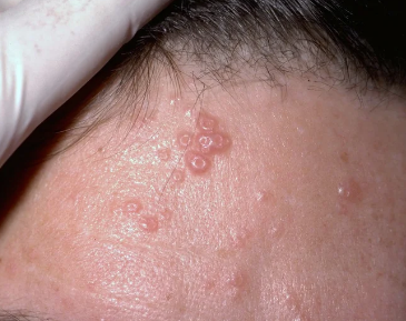 Molluscum Bumps