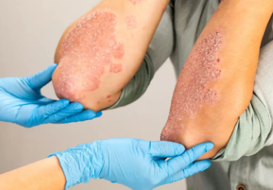 Psoriasis Treatment
