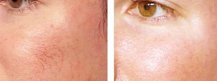 Telangiectasia Treatment