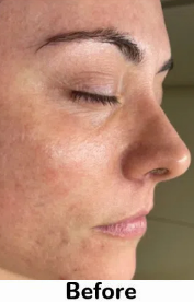 Before Advanced Hydra Facial