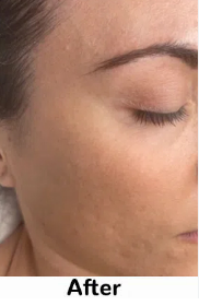 After Advanced Hydra Facial