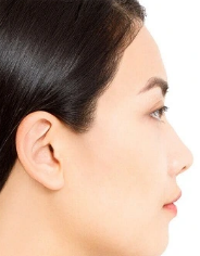 After Laser Hair Removal