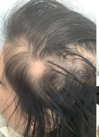 About Alopecia
