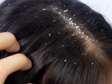 Anti Dandruff Treatment