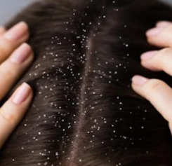 Dandruff Causes