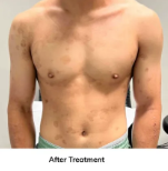 After Eczema Treatment