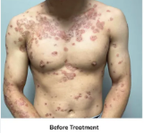 Before Eczema Treatment