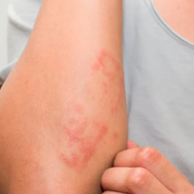 Atopic Dermatitis Treatment