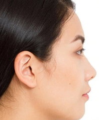 Before Laser Hair Removal