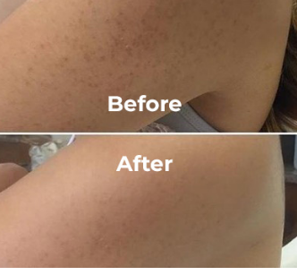 Body Peel Treatment