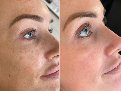 Chemical Peel Treatment