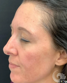 After Chemical Peeling