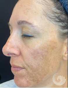 Before Chemical Peeling