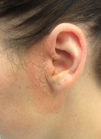 Before Dermatitis Treatment