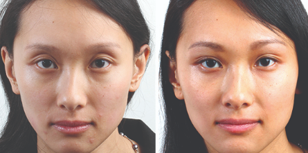 Face Lifting Treatment