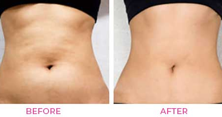 Live Fat Freezing Treatment