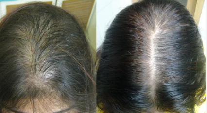 Hair Fall Treatment
