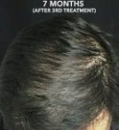 Hair Growth PRP