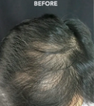 Hair Growth PRP