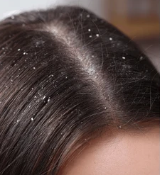 Before Scalp Treatment