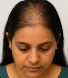 Before Hair Transplant