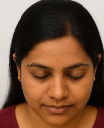 After Hair Transplant