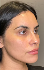 After Hydra Facial