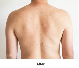 After Psoriasis Treatment