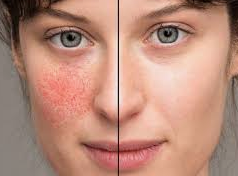 Rosacea Treatment