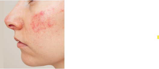 Before Rosacea Treatment