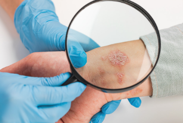 Skin Cancer Treatment