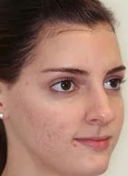 After Skin Polishing