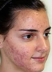 Before Skin Polishing