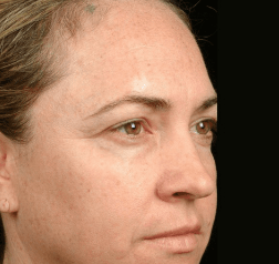 After Skin Tightening