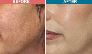 Skin Toning Treatment Vasai