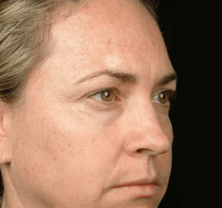 Before Skin Tightening