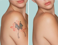 Tattoo Removal Vasai
