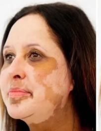 Before Vitiligo Treatment